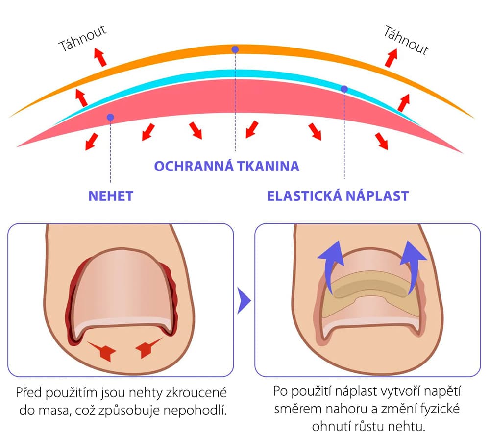 Wellife Náplasti proti zarůstání nehtů 100 ks - náhled 5