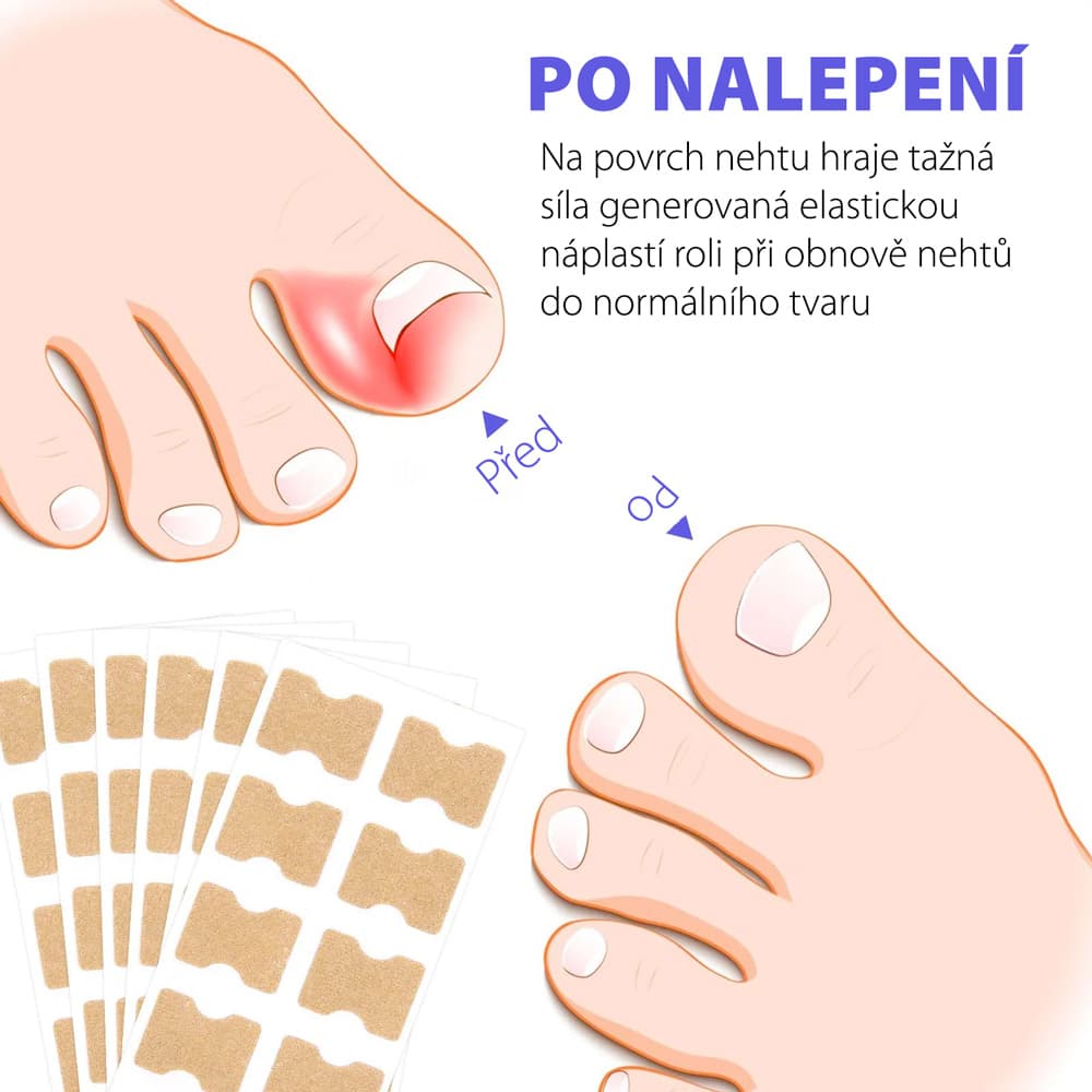 Wellife Náplasti proti zarůstání nehtů 100 ks - náhled 3